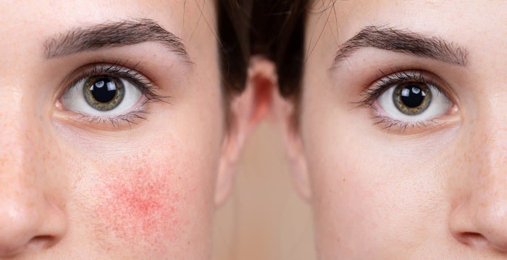 Rougeurs Visage : Comprendre et Apaiser Votre Peau